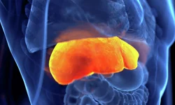 Metabolik karaciğer hastalığı alarm veriyor: 2050'ye kadar 1,8 milyar kişi risk altında